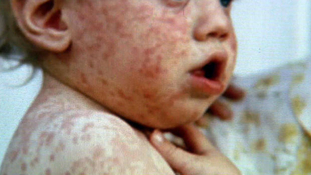 Third case of measles in Utah County totals 41 reported in four US states