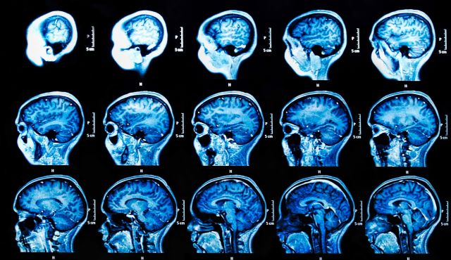 Biogen Alzheimer drug slows mental decline