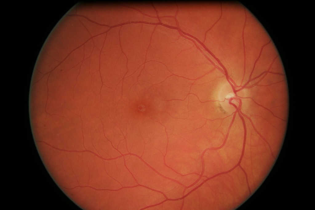 Gene Therapy temporarily restores eyesight in LCA caused retinal sensitivity