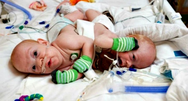 Conjoined twins miracle in Florida