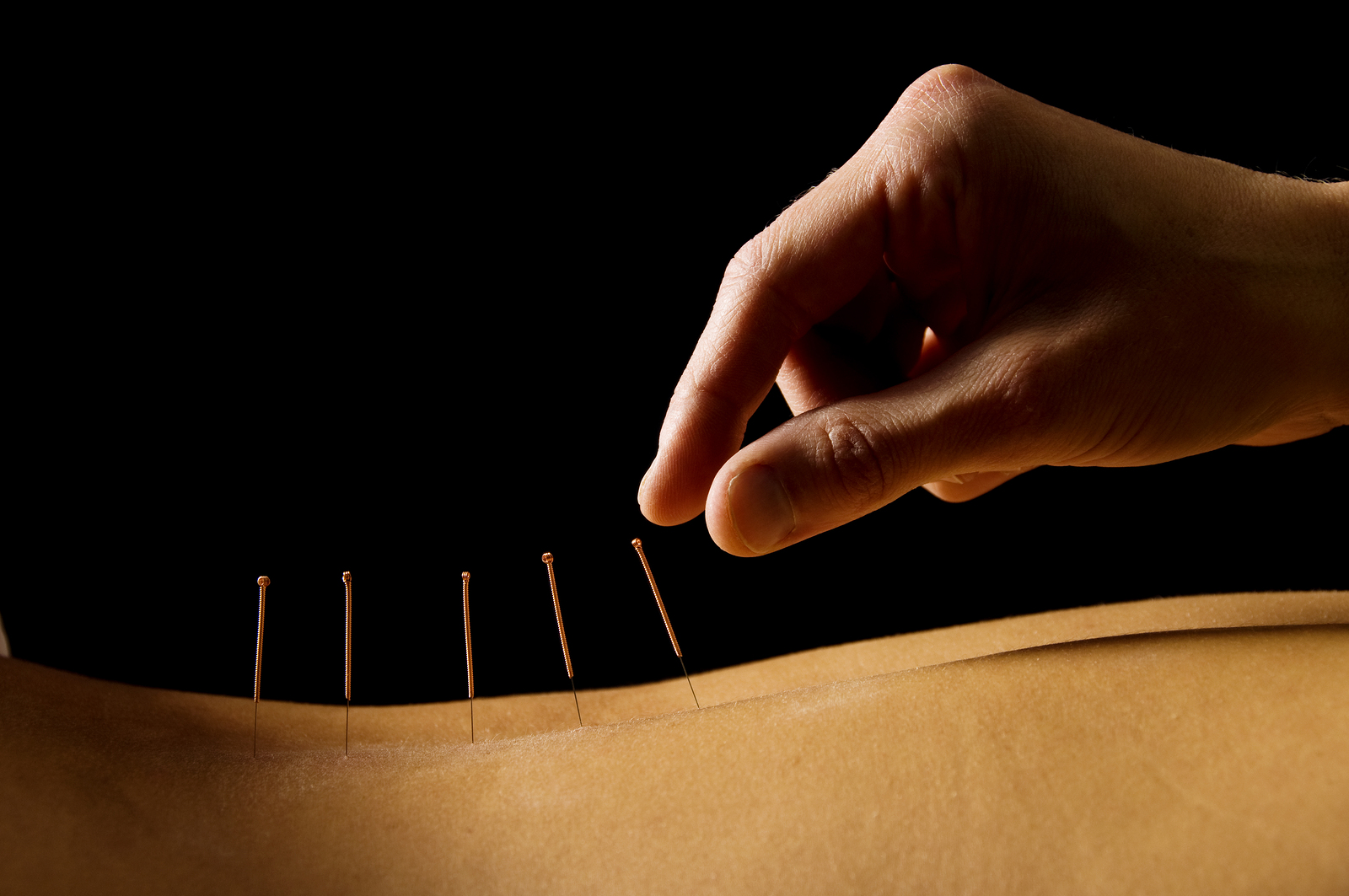 Acupuncture may relieve pain in fibromyalgia patients