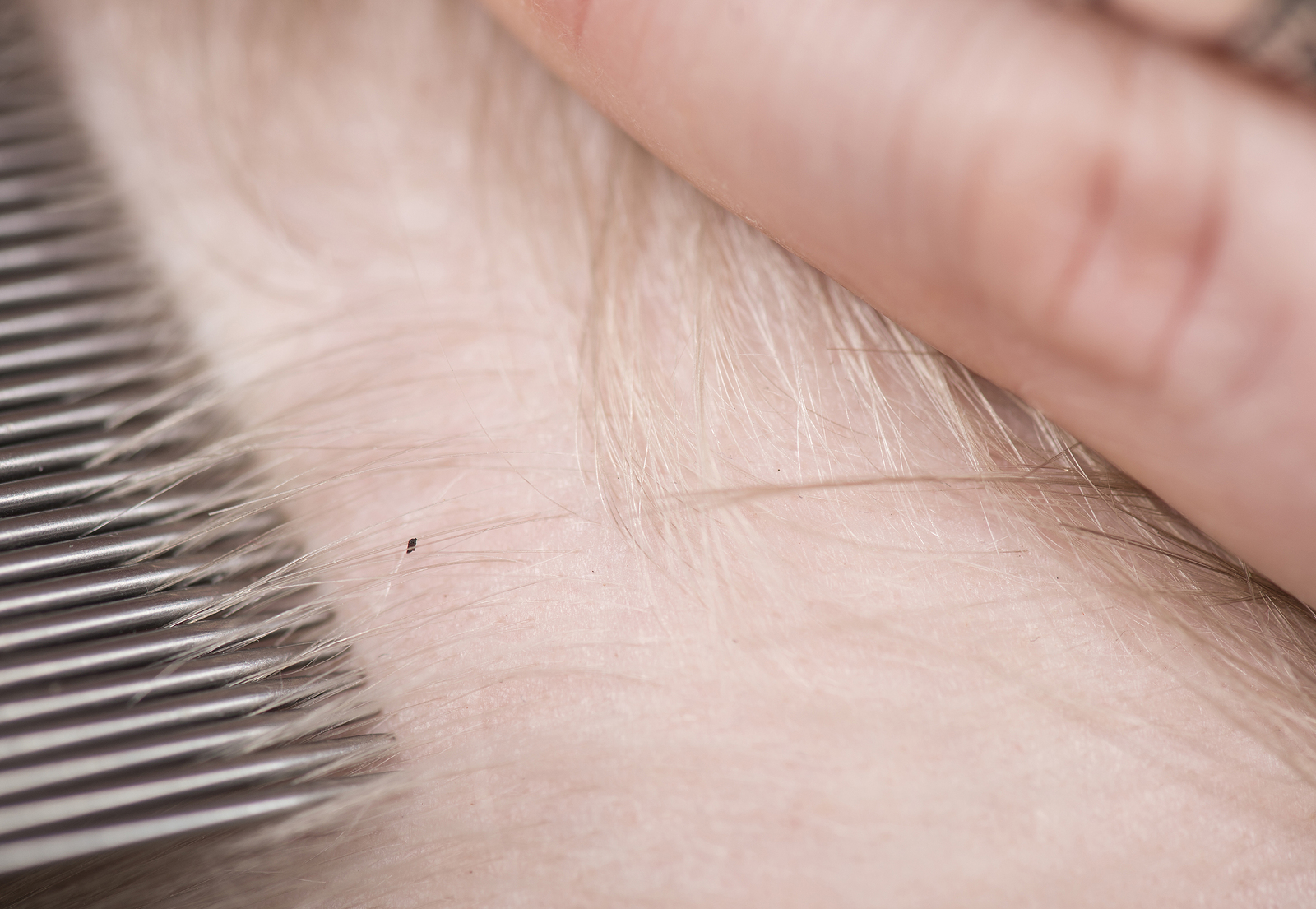“Super lice” found in 25 states – resistant to typical treatments