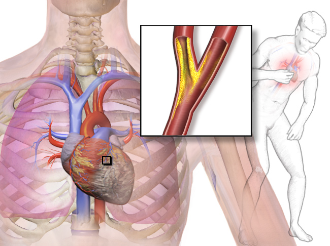 Heart attacks: Almost fifty percent could be ‘silent’