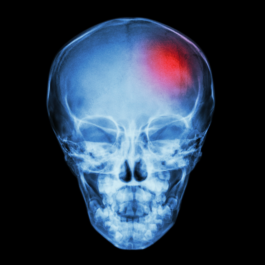 Startling new study shows stroke patient recovery aided by adult stem cell injection