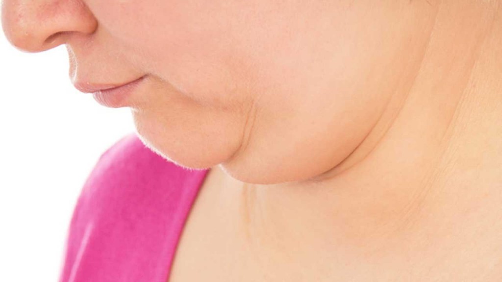 FDA approves new drug to treat double chin problem