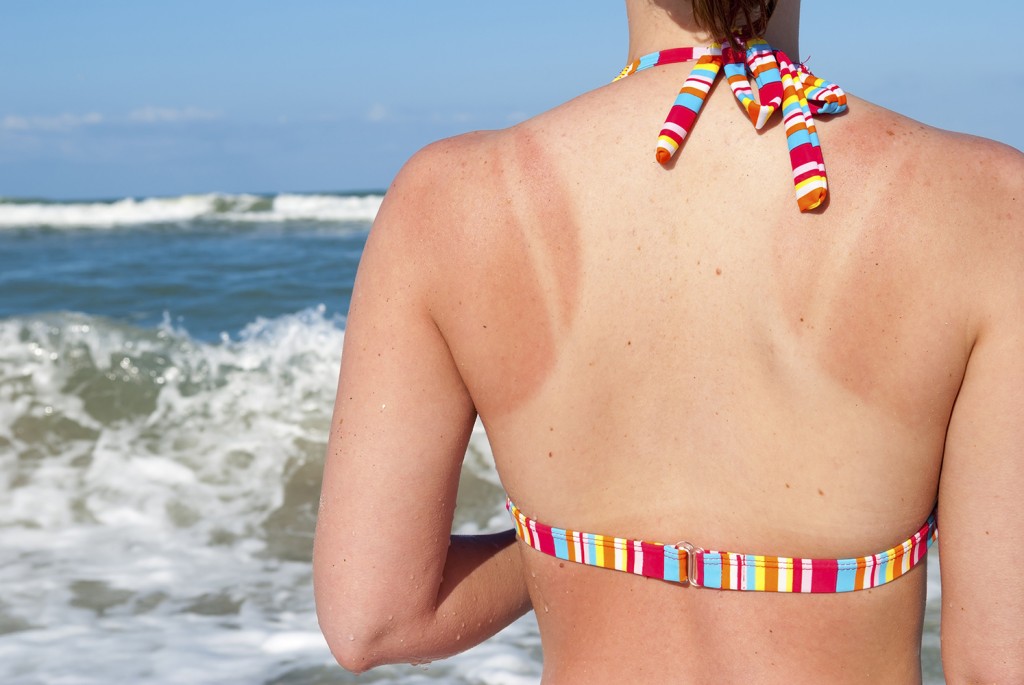 Study says majority of British at risk of getting skin cancer