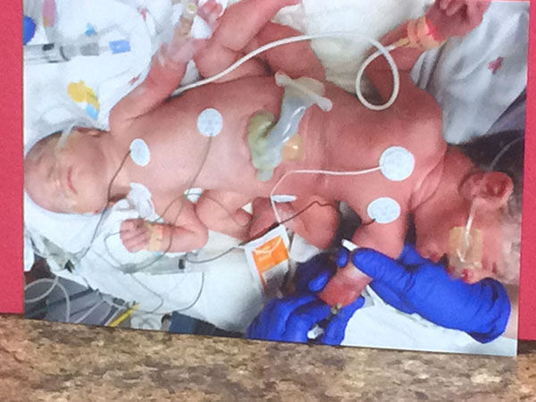 Triplets girls with two conjoined born at the Corpus Christi Medical Center in Texas
