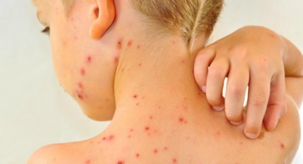 Stunning Chickenpox discovery floors scientists